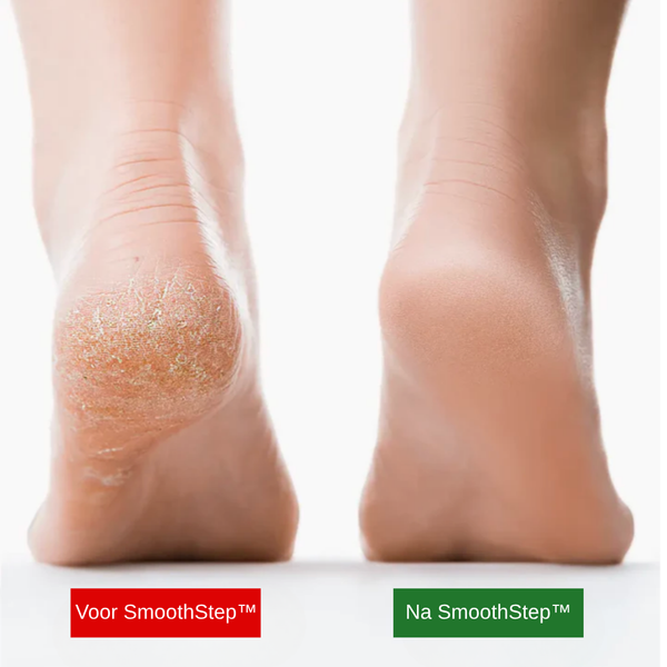 SmoothStep™ – Gladde voeten in slechts enkele minuten